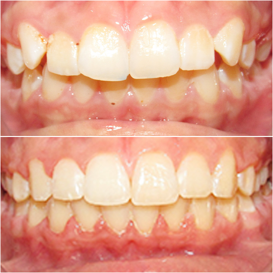 TruSmile Ortho Before and After Orthodontic Treatment