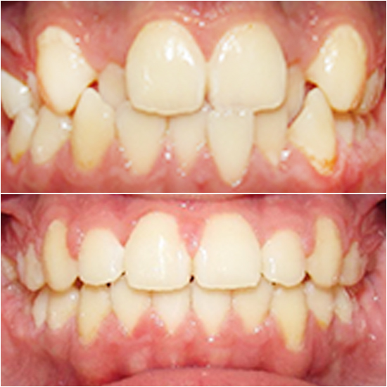 TruSmile Ortho Before and After Orthodontic Treatment
