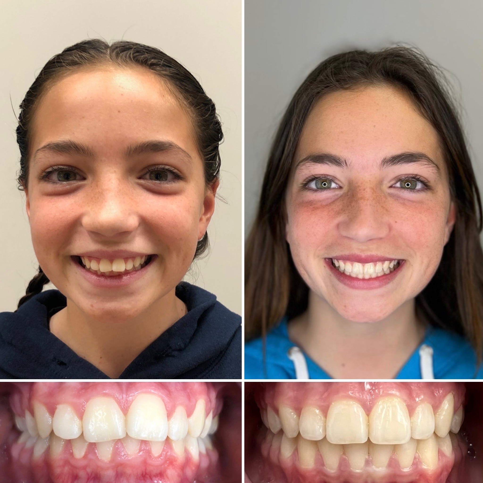 TruSmile - Before and After Orthodontic Treatment