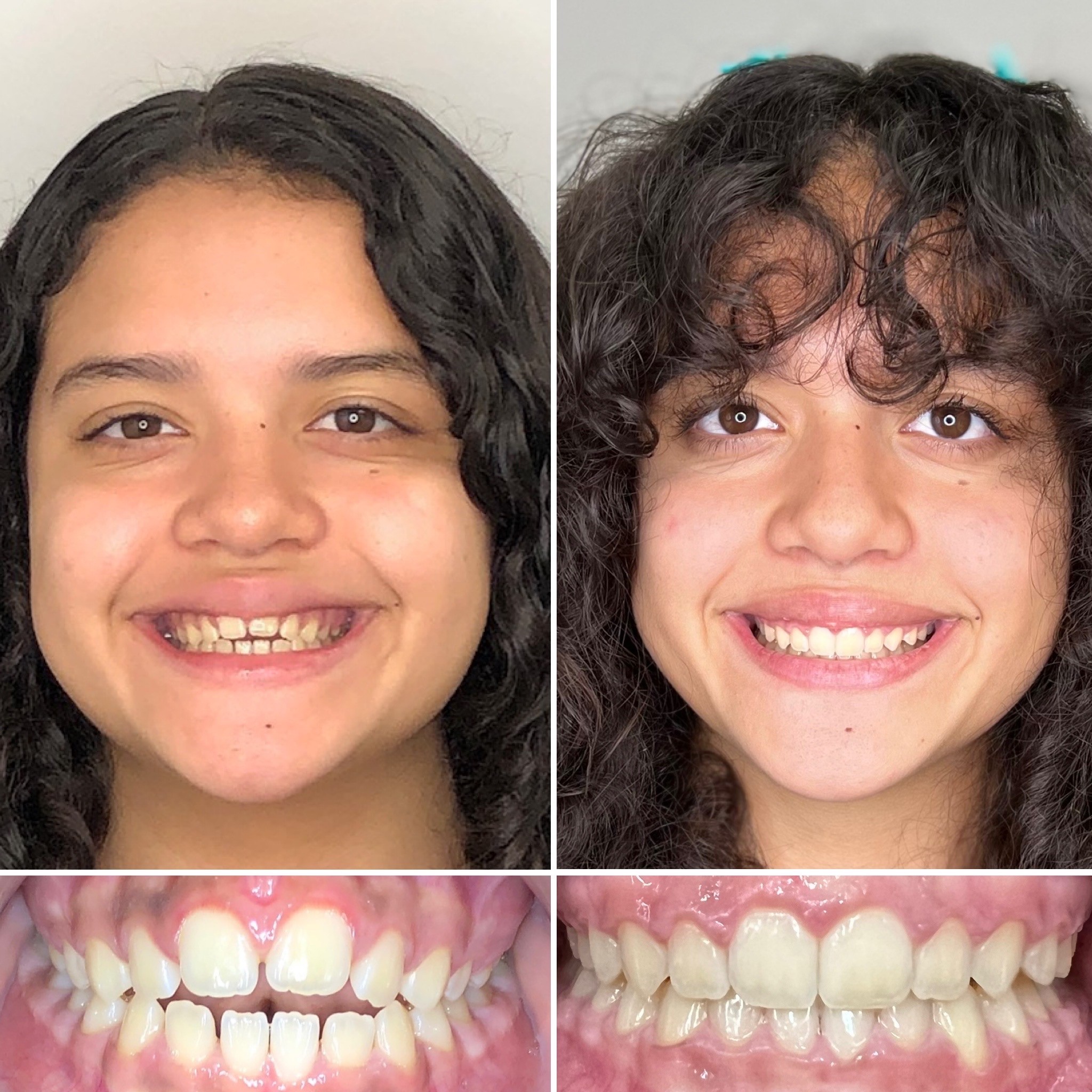 TruSmile - Before and After Orthodontic Treatment