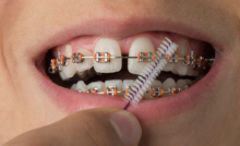 Flossing with Braces - Orthodontic Flossers, Threaders, and Water Flossers