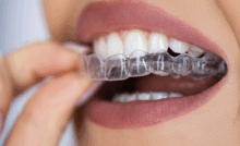 A woman is applying retainers to her teeth, focusing on her smile in a bright, well-lit room.