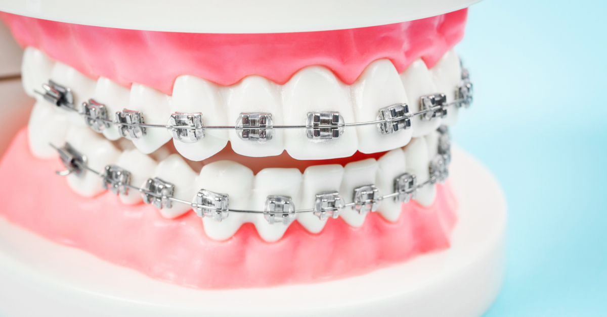 How to Get Braces Covered by Medical Insurance