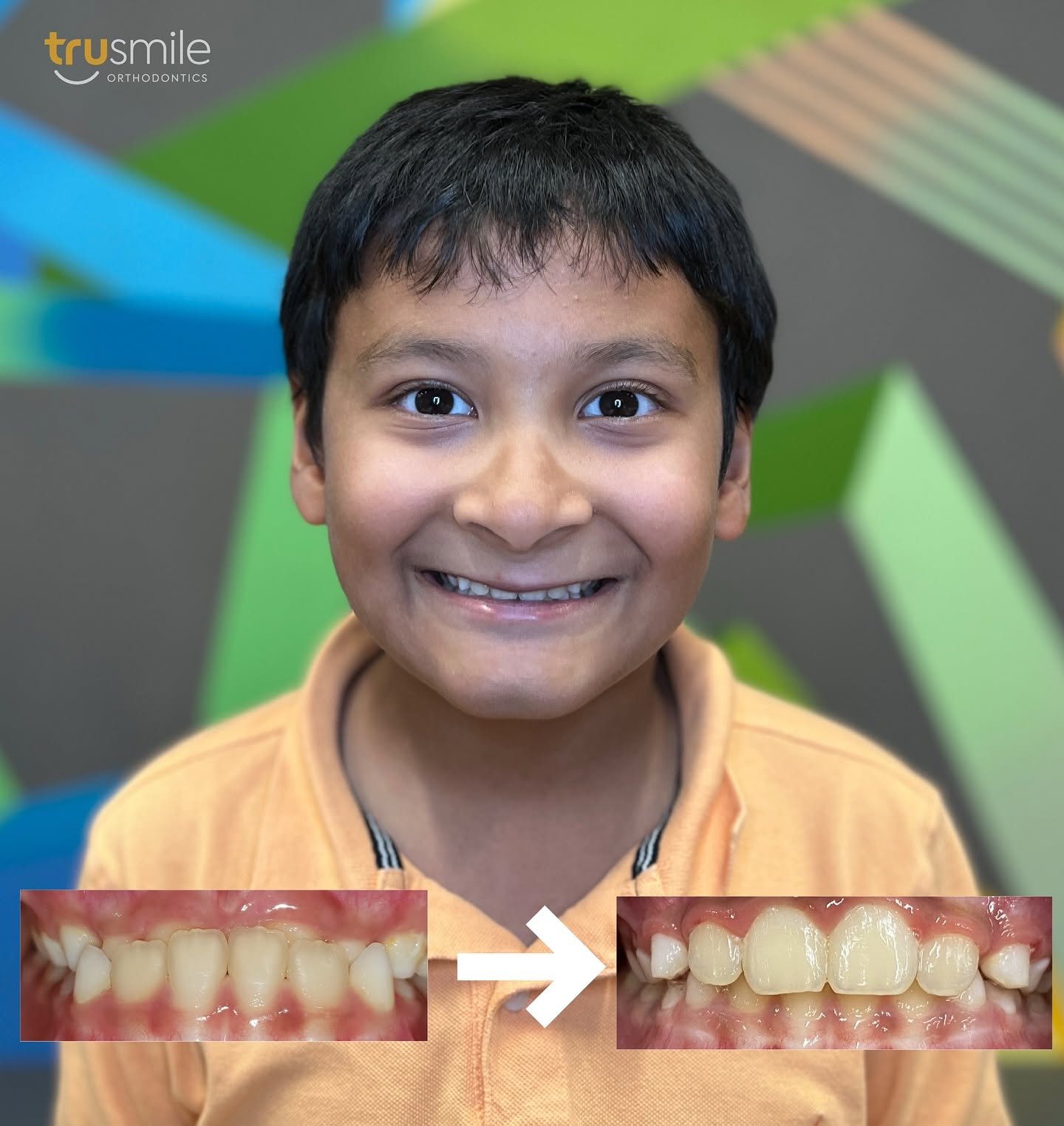 Early Orthodontic Treatment Why Timing Matters for Your Child's Smile