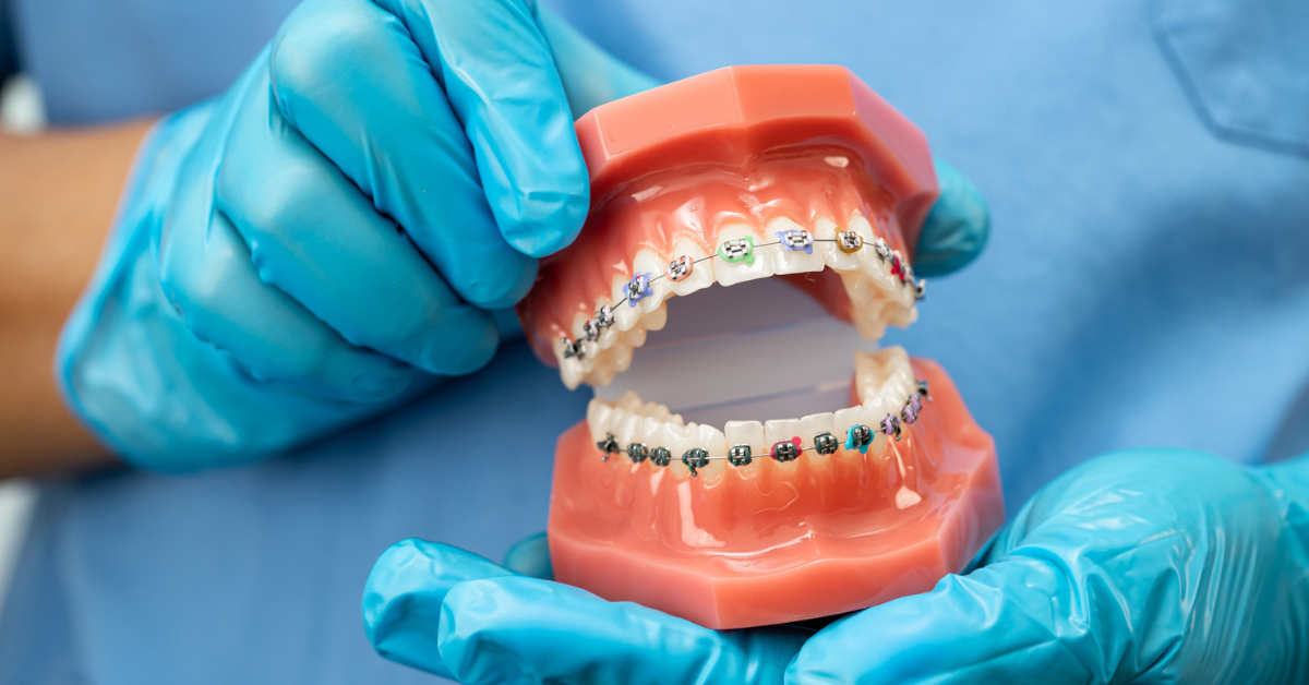 Underbite Causes, Symptoms, and Treatment Options in Long Beach